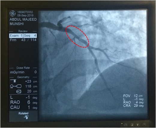 A narrowed coronary artery